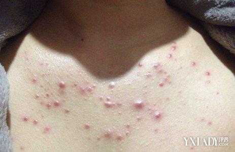 胸口起痘痘是什么原因,长粉刺痘痘的原因和解决方法