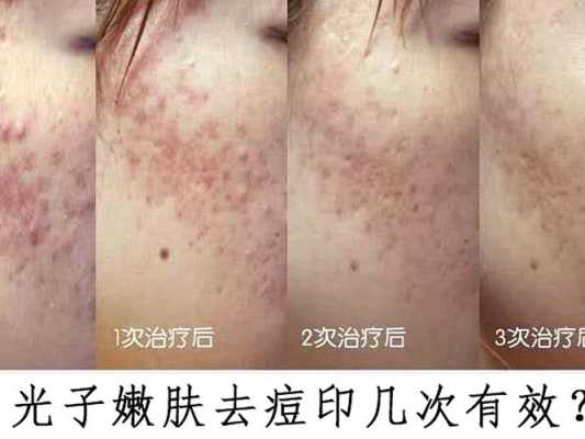 怎么才能有效去痘印（去痘印有什么好方法）