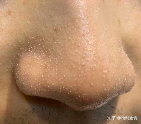 毛孔出大有黑头怎么办（怎么解决黑头毛孔粗大）