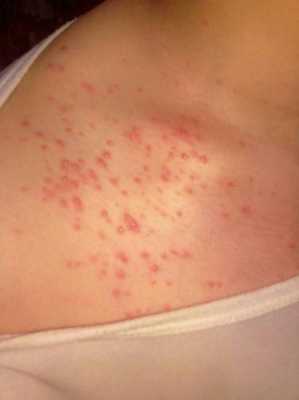 女生下面长豆豆怎么办（下面长痘痘怎么回事）