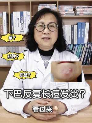 长在下巴的痘怎么消,下巴长痘痘怎么办?