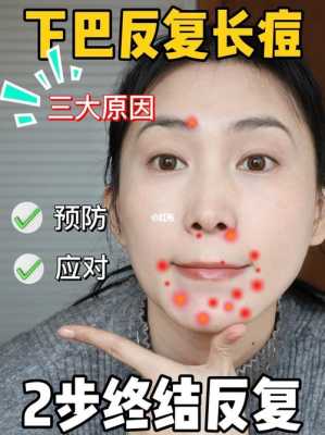 长在下巴的痘怎么消,下巴长痘痘怎么办?