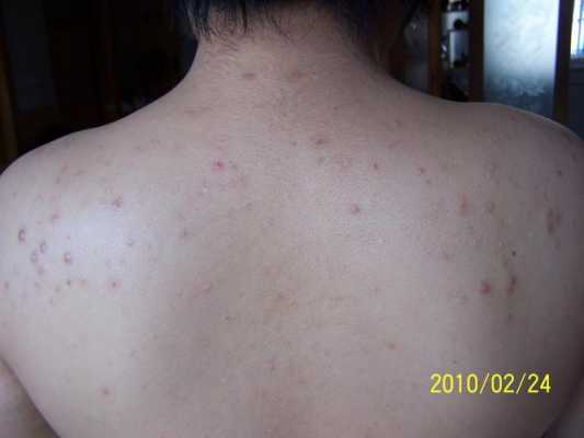 背上长痘痘是什么（背部长痘痘怎么回事）
